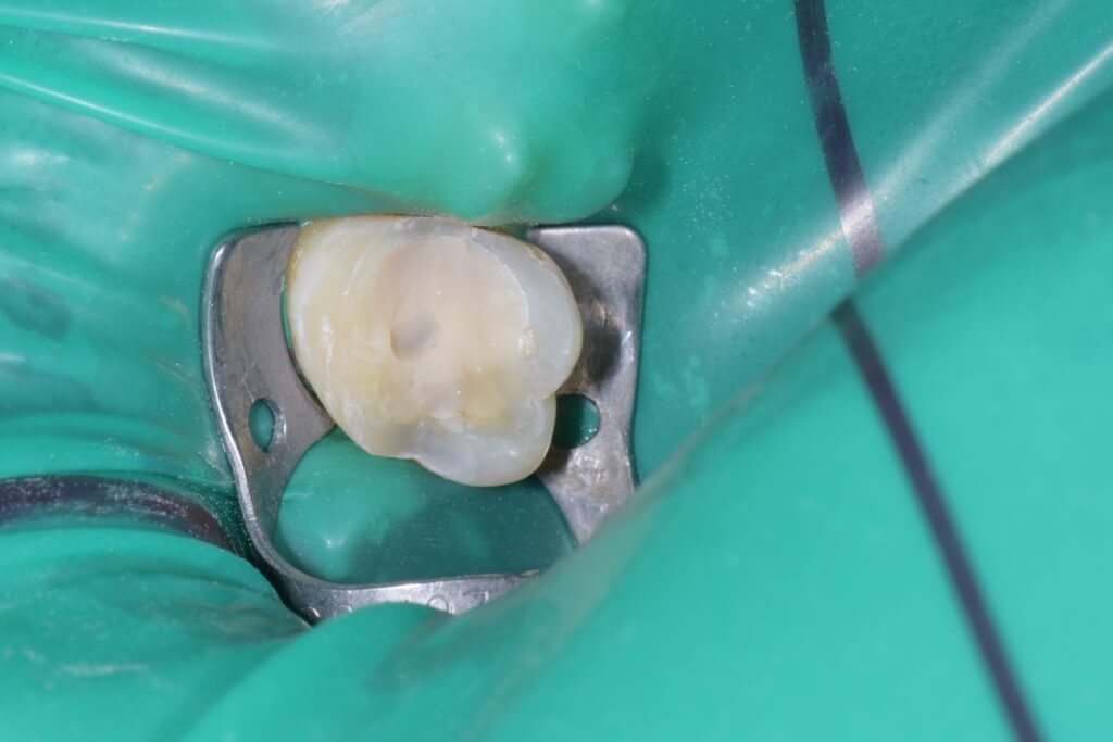 traitement d'une dent lors d'une intervention de dentisterie adhesive